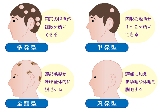 円形脱毛症★金沢薬局
