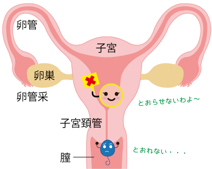 子宮頸管の精子通過障害★金沢薬局