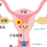 子宮頸管の問題
